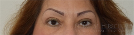 Blepharoplasty After