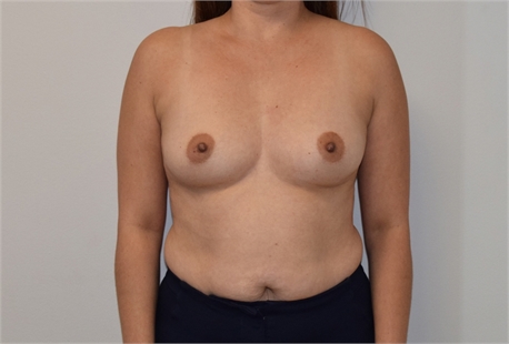 Breast Augmentation Before