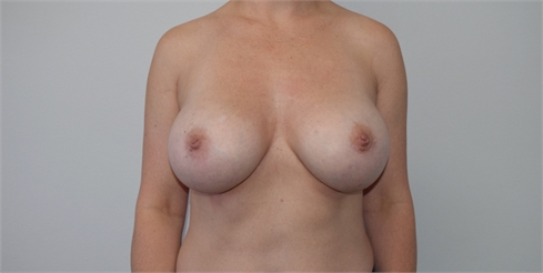 breast augmentation After