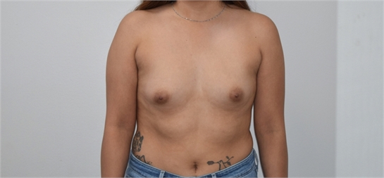 breast augmentation Before