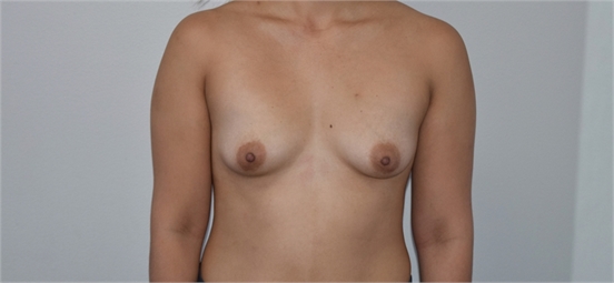 breast augmentation Before