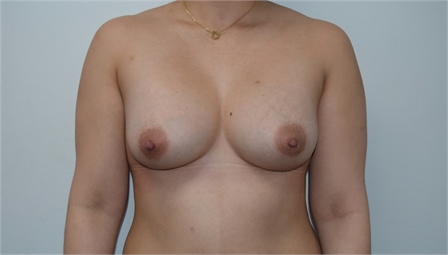 breast augmentation After