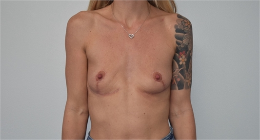 secondary breast augmentation Before