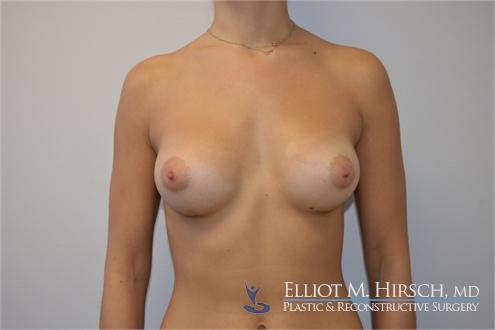 Breast Augmentation After