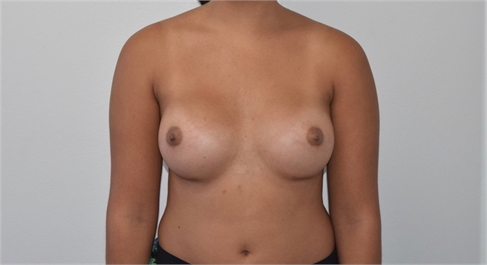 Breast Augmentation After