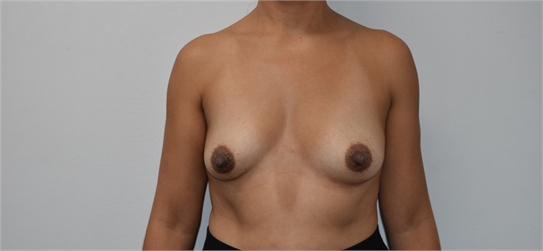 breast augmentation Before