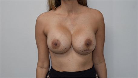 Breast Implant Revision After