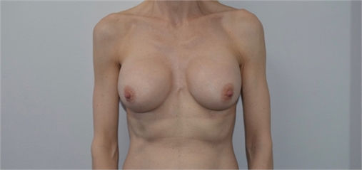 Breast Implant Revision Before