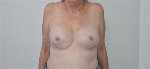 Breast Implant Revision After