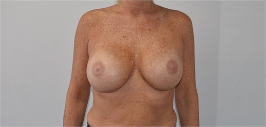 Breast Implant Revision After