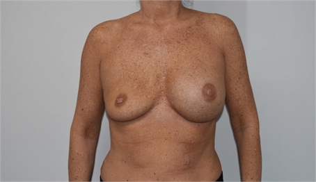 Breast Implant Revision Before