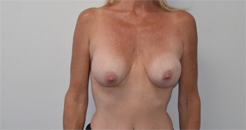 breast implant revision Before