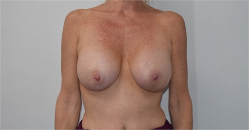 breast implant revision After