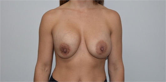 breast implant revision Before