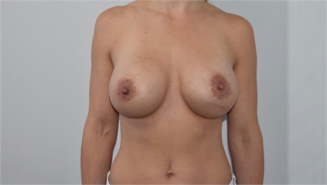 breast implant revision After