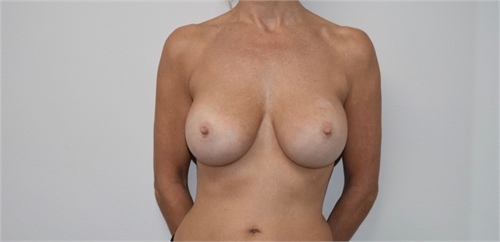 breast implant revision After