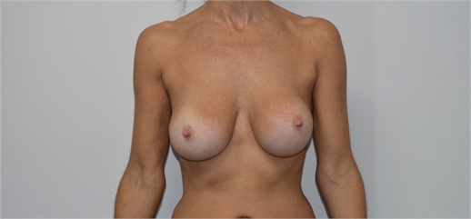 breast implant revision Before