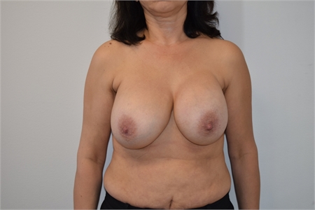 Breast Implant Revision Before