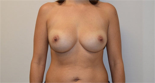 Breast Implant Revision After