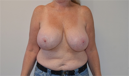 explant and mastopexy Before