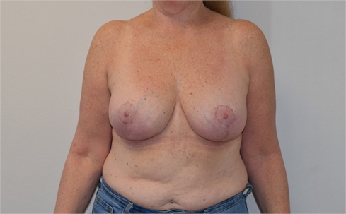 explant and mastopexy After
