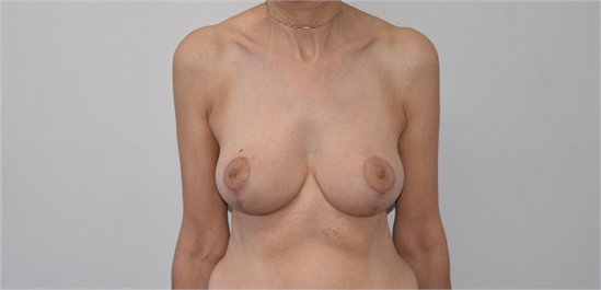 Breast Lift After
