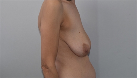 Breast Lift Before