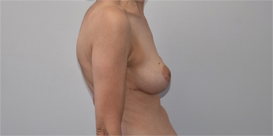 Breast Lift After