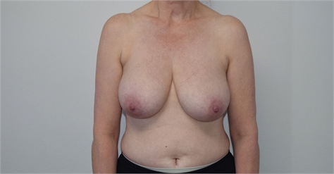 Breast Lift Before