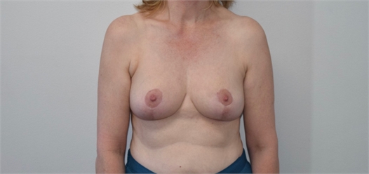 Breast Lift After