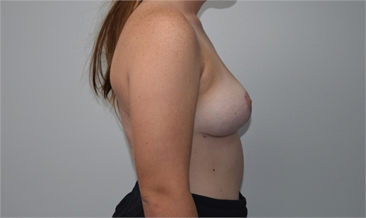 breast lift with mesh After