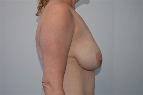 breast lift mastopexy with mesh Before