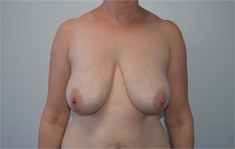breast lift mastopexy with mesh Before