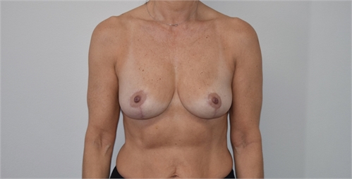 Breast Lift After
