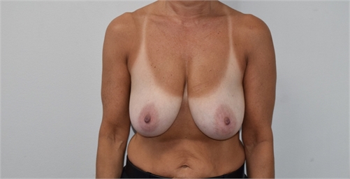 Breast Lift Before