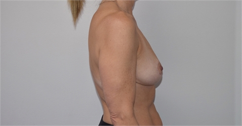 Breast Lift After