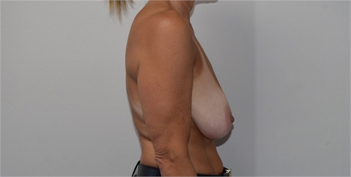 Breast Lift Before