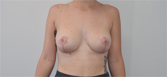 Breast Lift After