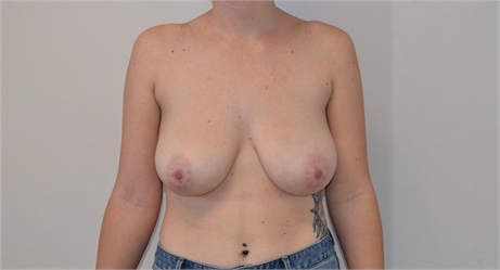 Breast Lift Before
