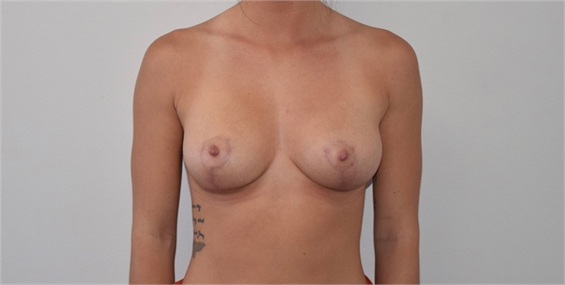 Breast Lift After