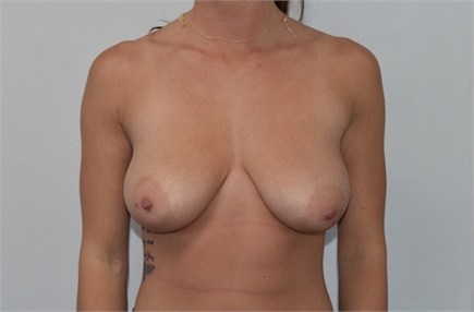 Breast Lift Before