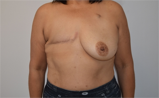 Two Stage Breast Reconstruction Before