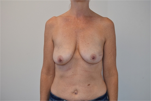 Two Stage Breast Reconstruction Before