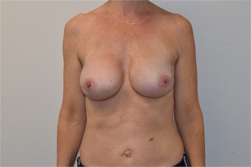 Two Stage Breast Reconstruction After
