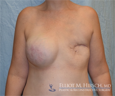 Two Stage Breast Reconstruction Before