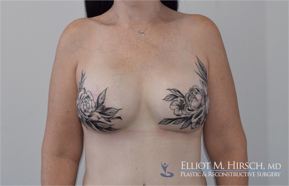 Two Stage Breast Reconstruction After