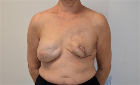 Breast Reconstruction Revision Before