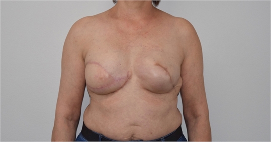 Breast Reconstruction Revision After