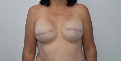 breast reconstruction After