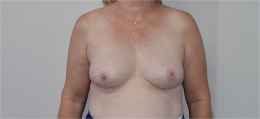 breast reconstruction Before